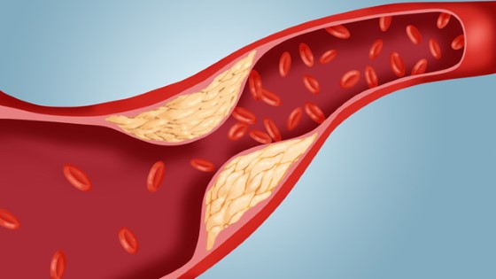Hromaděním cholesterolu může docházet k postupnému ucpávání a ztenčování tepen a cév, což vede k rozvoji kardiovaskulárních onemocnění; zdroj foto: wikinow.in